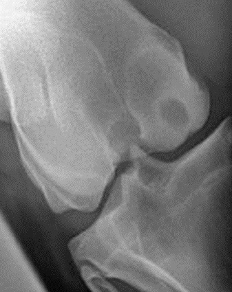 Fig 3 A typical bone cyst in a stifle joint